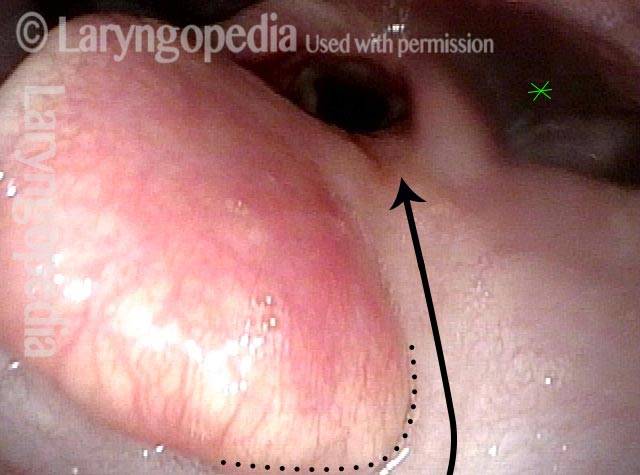 epiglottis is tethered to base of tongue