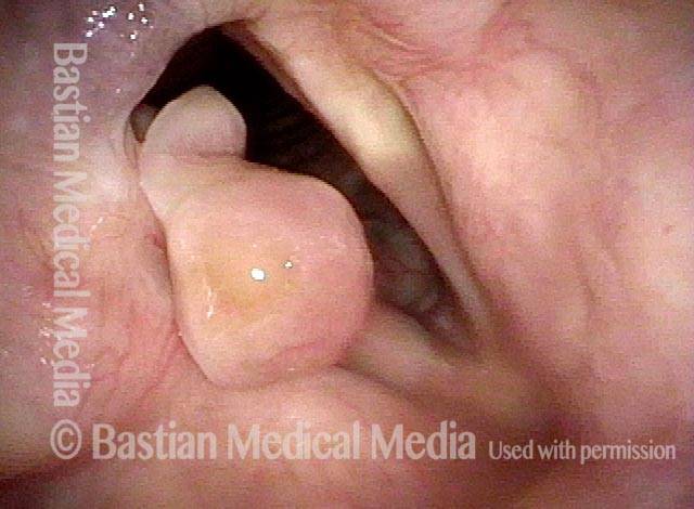 inferior lobule of the granuloma has begun to fall off