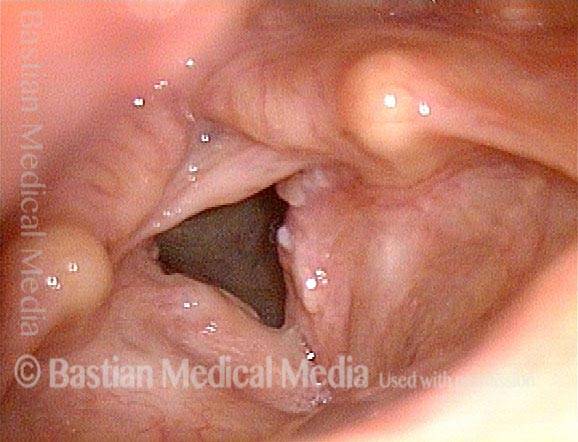 Vocal cords are re-adhering where the web was divided two weeks earlier