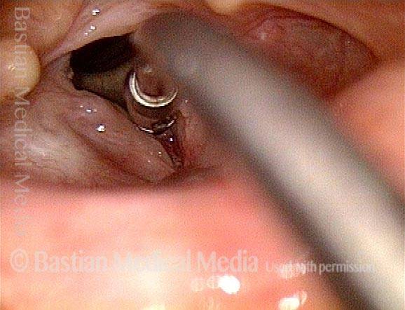 Slight bleeding at point of re-separation of the cords