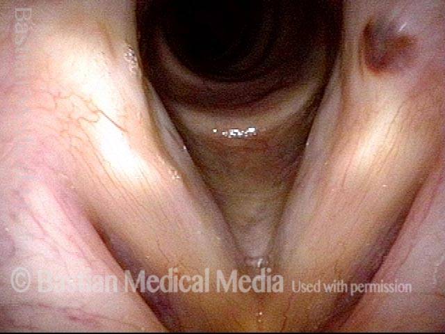 upper lobule has now detached