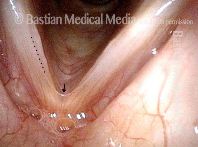broad-based swelling of both vocal cord margins