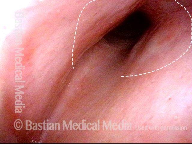 redness and narrowing of the posterior subglottic airway