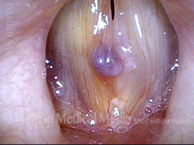 Hemorrhagic polyp