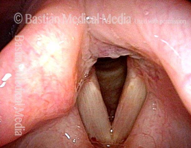 Vocal cords six days post surgery