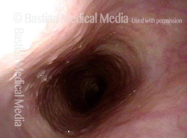 Cervical esophagus