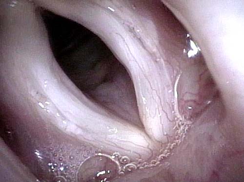 Vocal Cords at closed phase