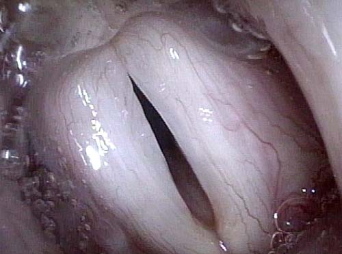 the gap is wider anteriorly