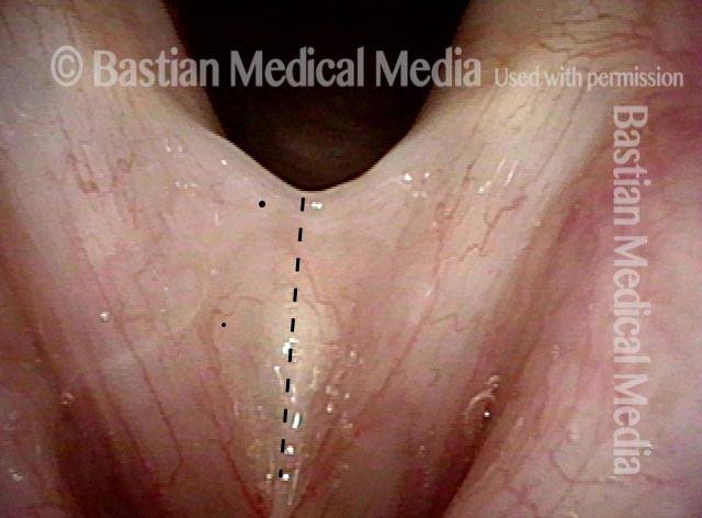 glottic web attaches most of both vocal cords together