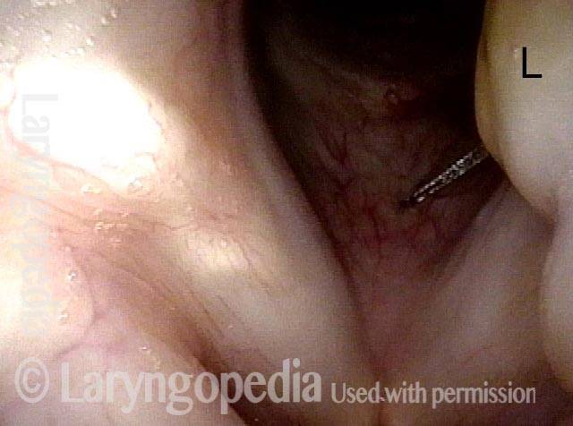 Injection into lower lobe