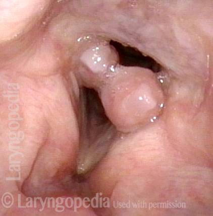 Intubation Granuloma