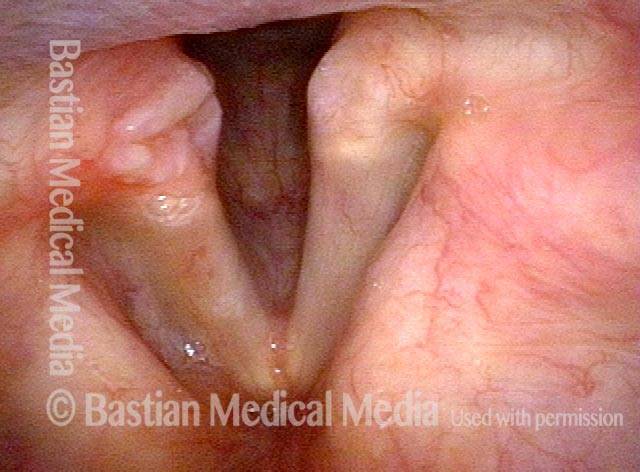 persistent lesion of his right vocal cord