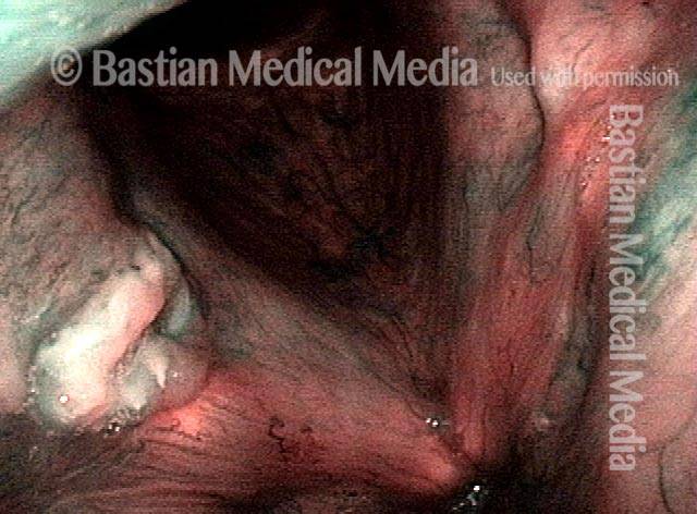 healed nature of the left vocal cord