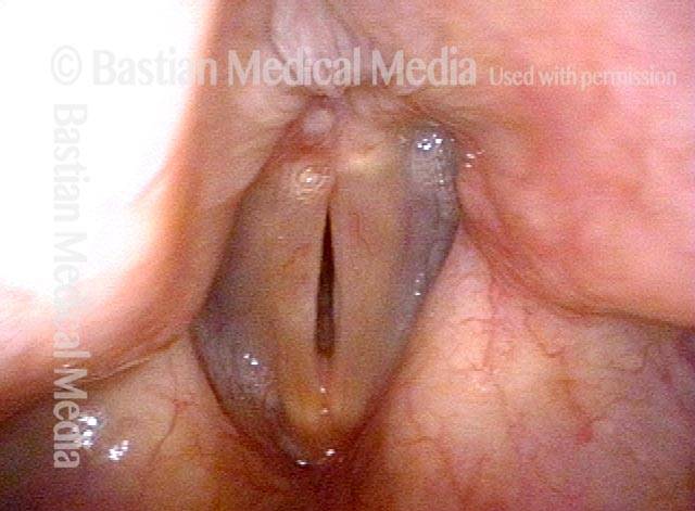 eft cord clearly fits into the cleft of the right sided lesion