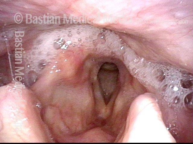 Hypopharyngeal pooling of saliva