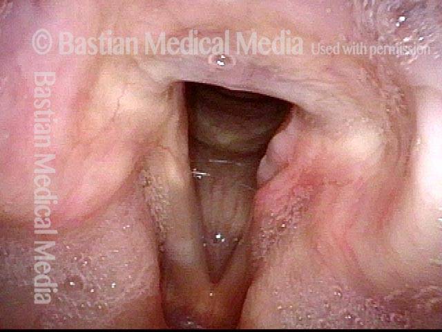 soiling of the laryngeal vestibule with saliva bubbles and contact granuloma