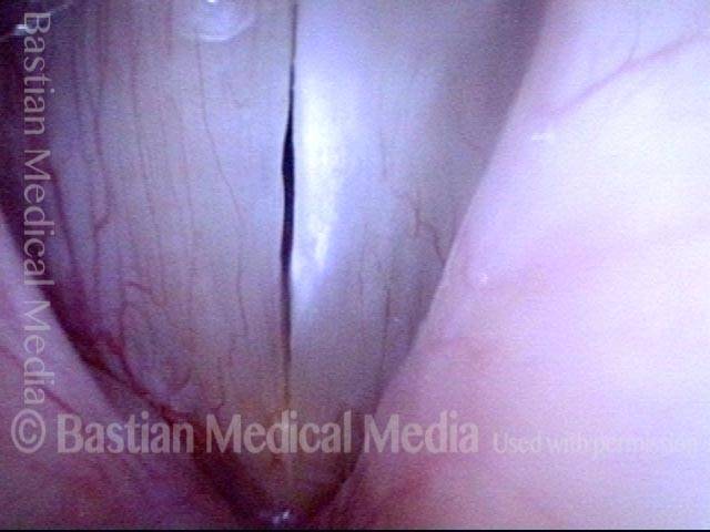 Gap between vocal cords during closed phase