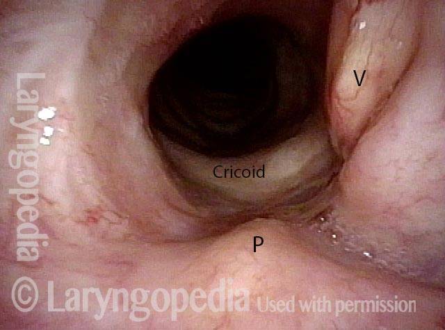 Interior of larynx
