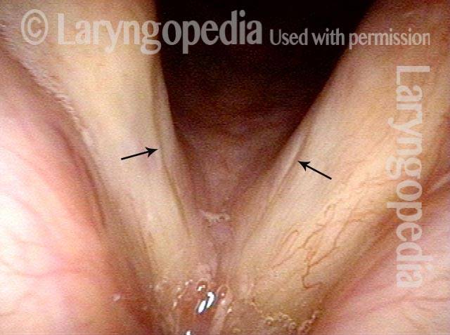 Bowing vocal cords with furrows