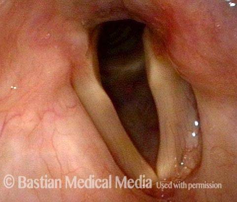 Vocal cord paralysis