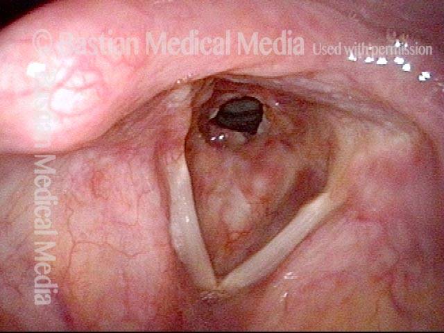 Subglottic stenosis, due to Wegener's