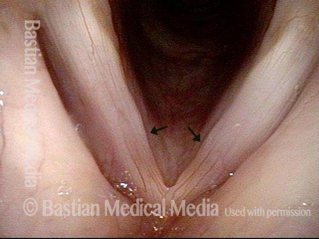 Bilateral vocal cord swellings
