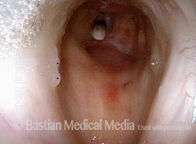 Closer view, between the posterior vocal cords