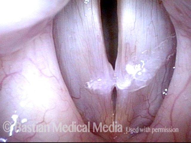 Vocal nodules