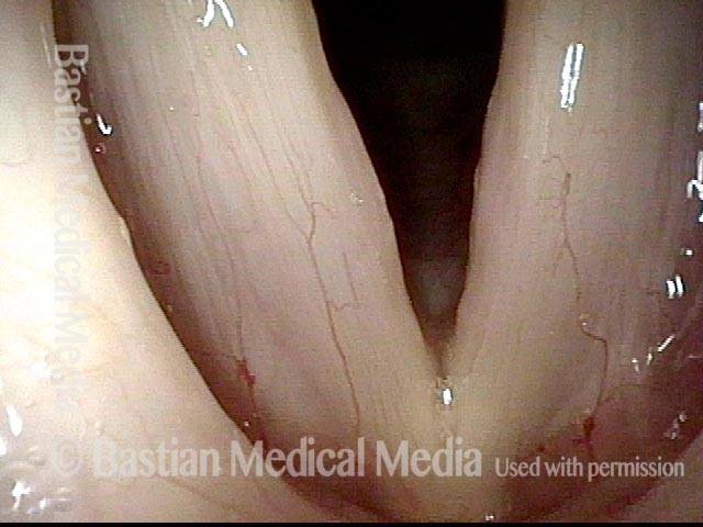 Vocal nodules, before surgery