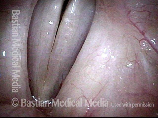 Vocal nodules, after surgery