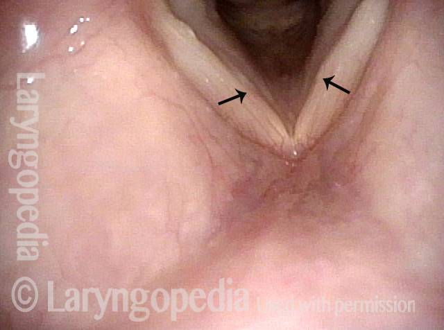 Vocal cord swellings are red herrings