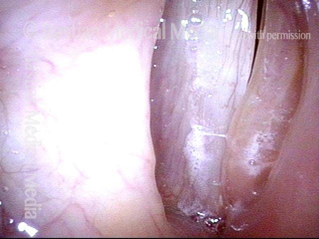 Extrusion of vocal cord implant