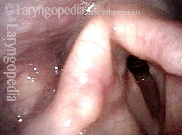 Intubated as preemie
