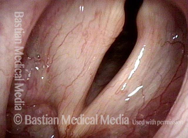 Paralysis of left vocal cord