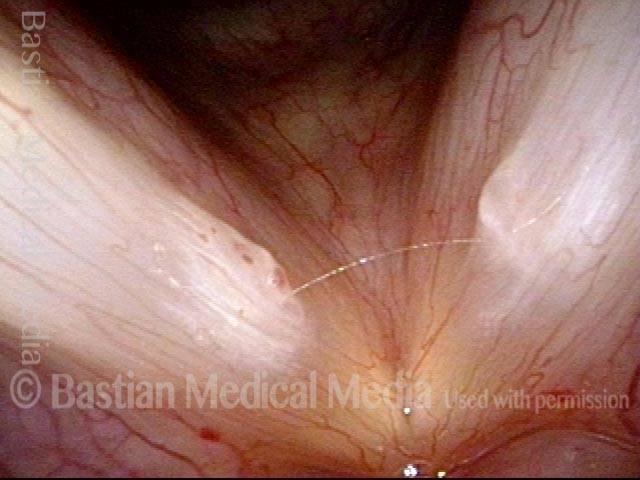 Vocal nodules, leukoplakia, and capillary ectasia