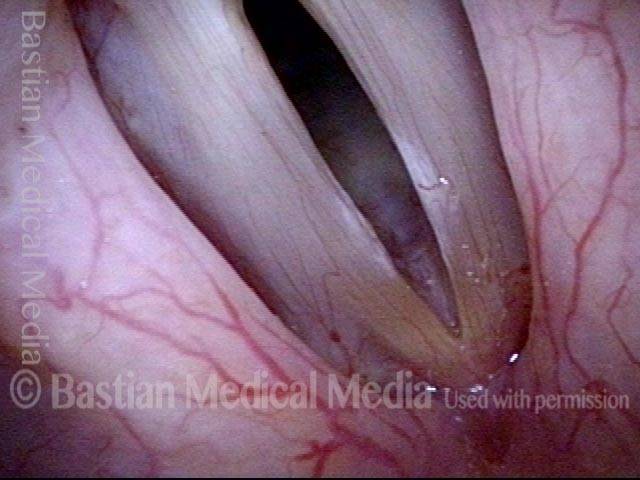 Vocal nodules, leukoplakia, and capillary ectasia: 6 months later