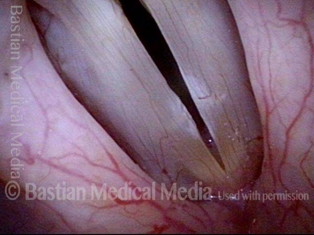 Vocal nodules, leukoplakia, and capillary ectasia: 6 months later