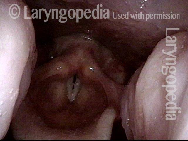 Tonsils enlarged