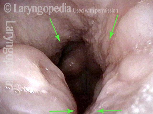 Tonsils in contact