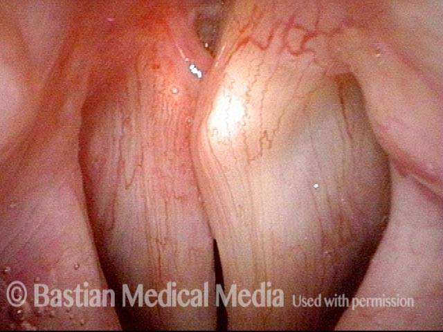 Scissoring of the vocal cords