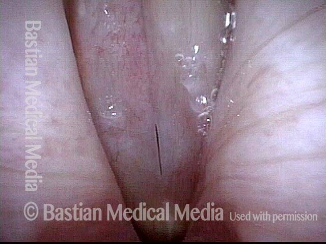 Leukoplakia, after surgical removal