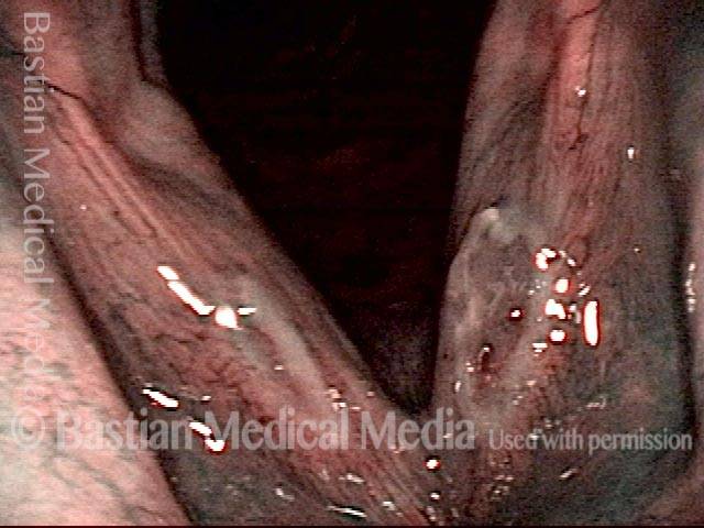 Ulcerative laryngitis