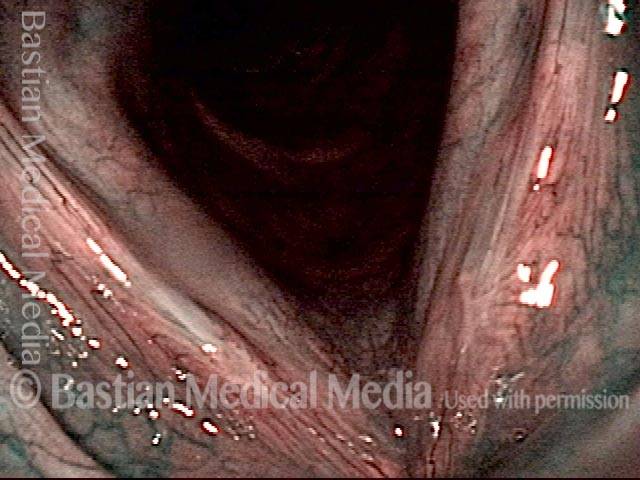 1 month later: ulcerative laryngitis healing