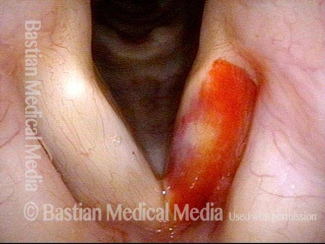 Vocal cord bruise / hemorrhage