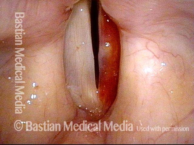 Vocal cord bruise / hemorrhage