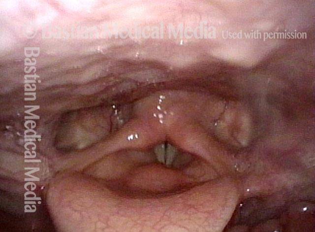 no pooling of saliva in the hypopharynx