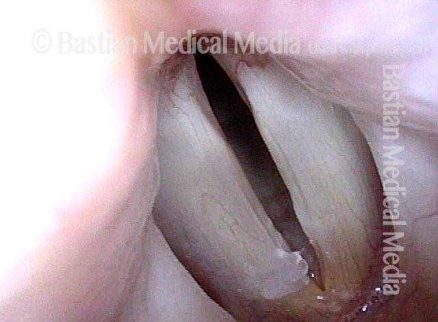 lengthening of the vocal cords