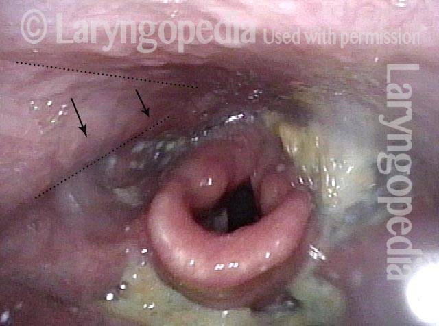 Residue during swallowing test
