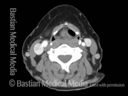 Laryngocele, seen in a CT image