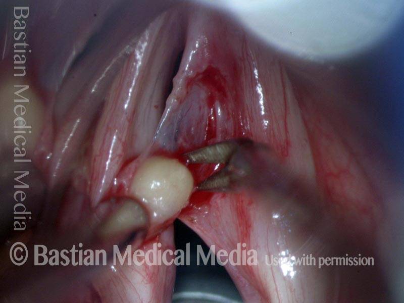 Removal of Mucus retention cyst